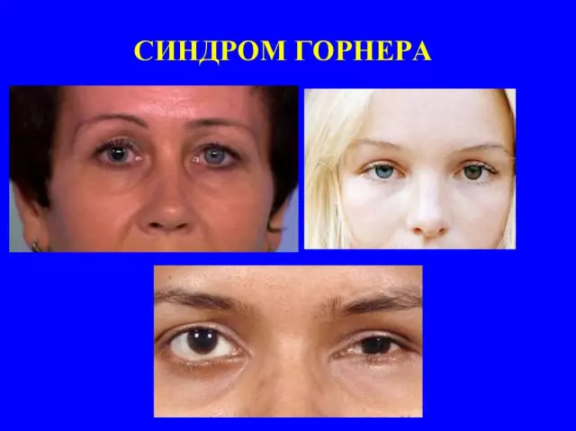Синдром Хорнера у собак - симптомы, диагноз и лечение