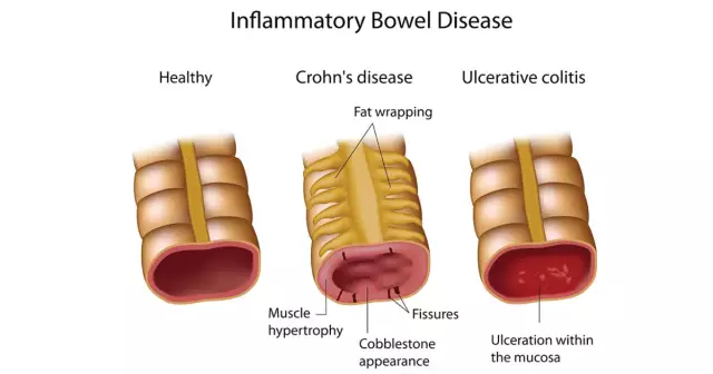 Является ли IBD заразительным?