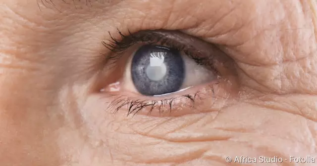 Каковы причины и лечение катаракты?