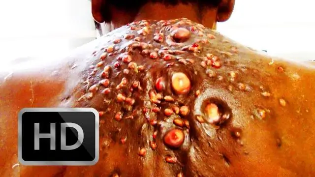 Каковы симптомы наличия ботвы?