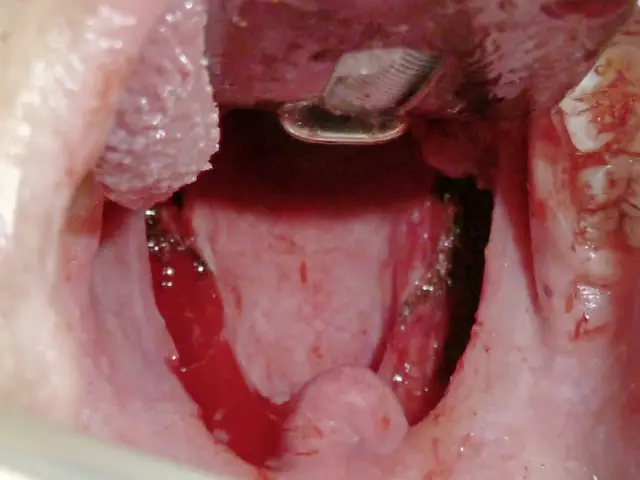 Донорские микробы сохраняются через два года после фекальной трансплантации для лечения инфекции, вызванной C. difficile: это первая демонстрация того, что донорские микробы сохраняются в реципиенте п