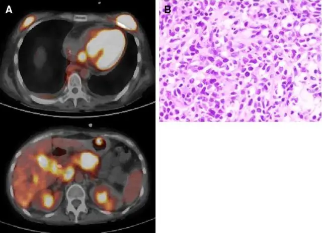 Болезни сердца, лейкемия связаны с дисфункцией ядра