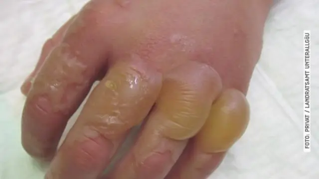 Каннибализм: новый способ остановить распространение болезни