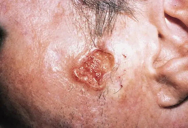 Агрессивные бактерии ИМП захватывают медь и питаются ею: результаты предлагают способы «уморить голодом» трудноизлечимые инфекции кишечной палочки