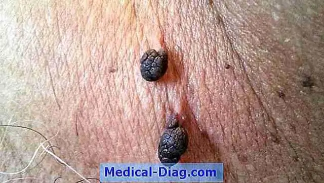 Яд ящерицы может содержать ключи к лечению тромбов