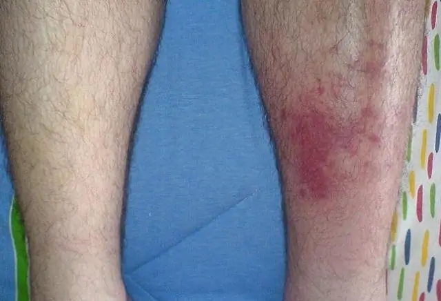 Бактерии пронзают амеб микрокинжалами