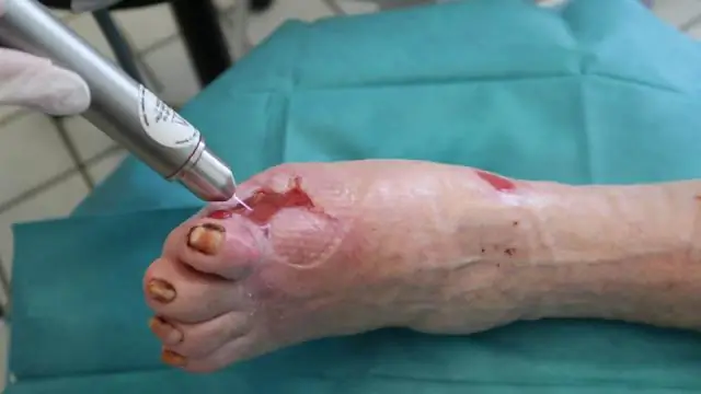 Ловушка полирезистентных бактерий в молекулярный клей