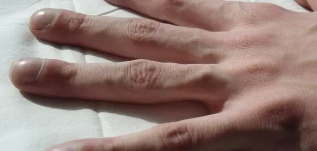 Как формируются фатальные биопленки