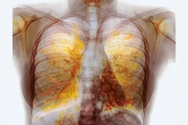 Бактериальные «спящие клетки» уклоняются от антибиотиков и ослабляют защиту от инфекций