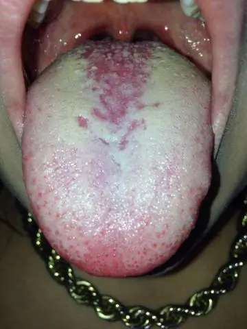 Как Candida albicans использует недостаток кислорода, чтобы вызвать заболевание