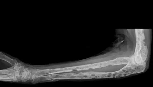 Лысый ген finding