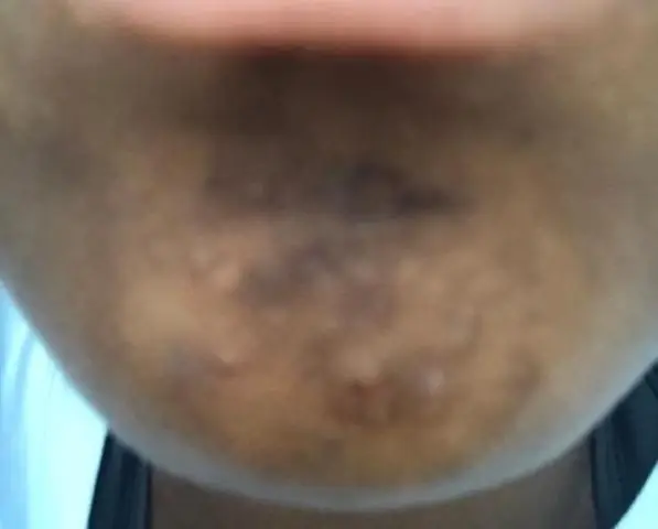 Дарвин может помочь вашему врачу: Эволюция и экология вдохновляют на клинические исследования инфекций и устойчивости к противомикробным препаратам