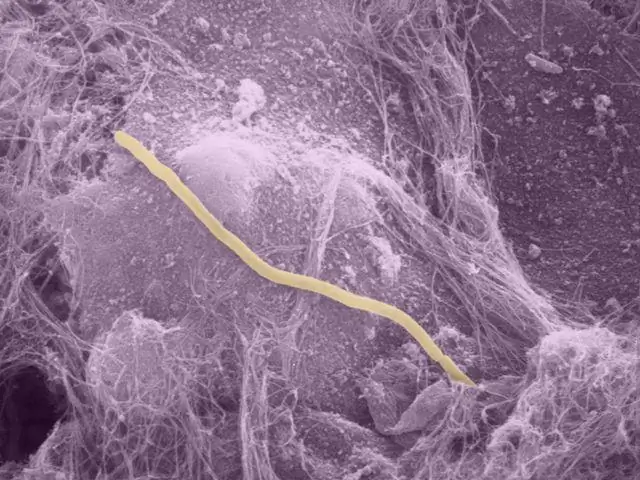 Е. coli superbug могут сохраняться в кишечнике здоровых женщин