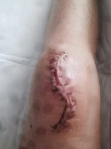 Бактерии, захваченные и обезвреженные графеновым фильтром: Графен, индуцированный лазером, для удаления патогенов из воздуха